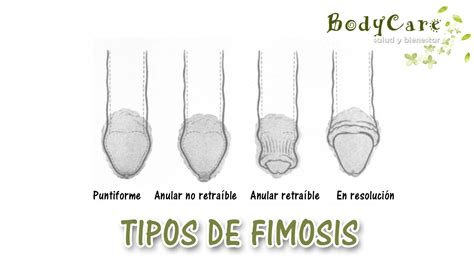 fimosis imagenes|Fimosis: causas, síntomas, complicaciones y tratamiento